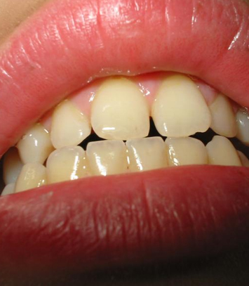 What Are The Causes Of Bruxism