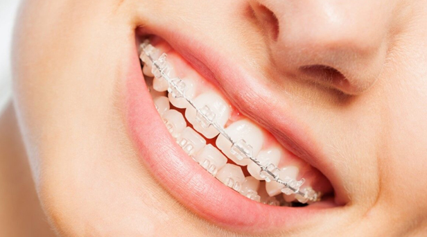 What Are Clear Braces