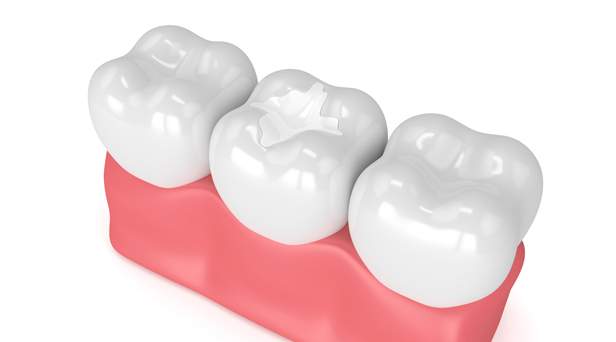 What Are Composite Fillings