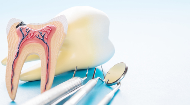 What Are Root Canals
