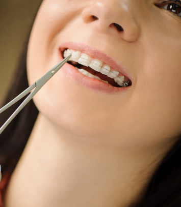What Can You Expect During The Procedure For Six Month Smiles 1