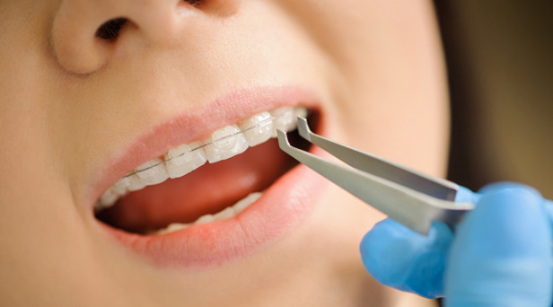 What Makes You A Candidate For Clear Braces 1