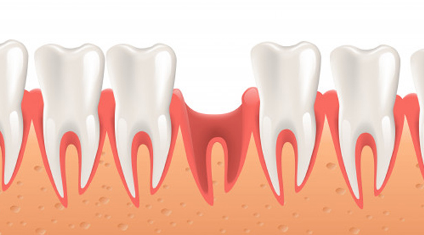 What Makes You A Candidate For Extractions