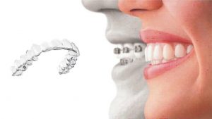 Invisalign Attacks What Are They And What Are They For