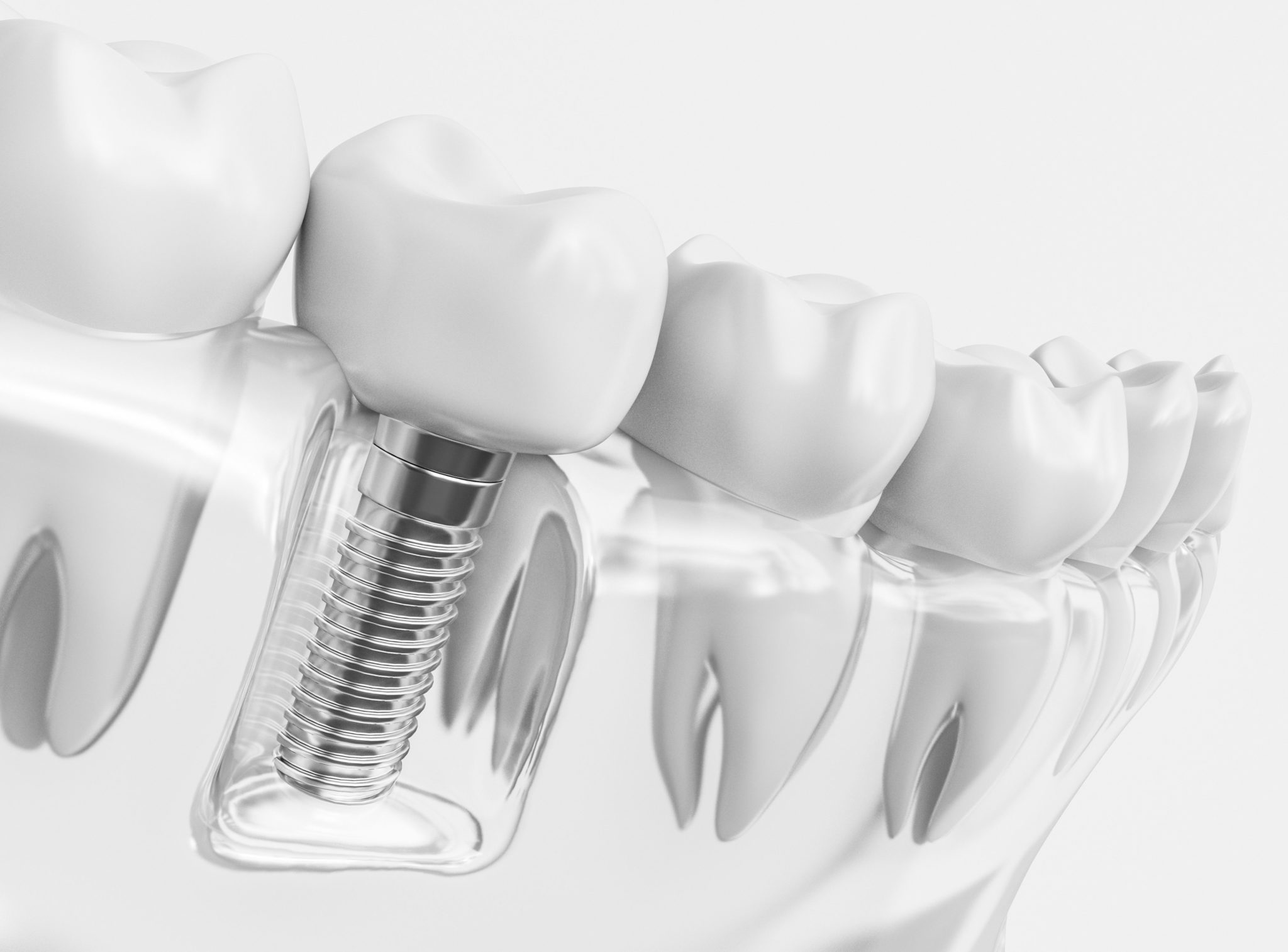 Dental Implant