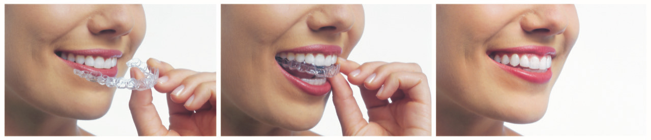 images of woman putting in invisalign