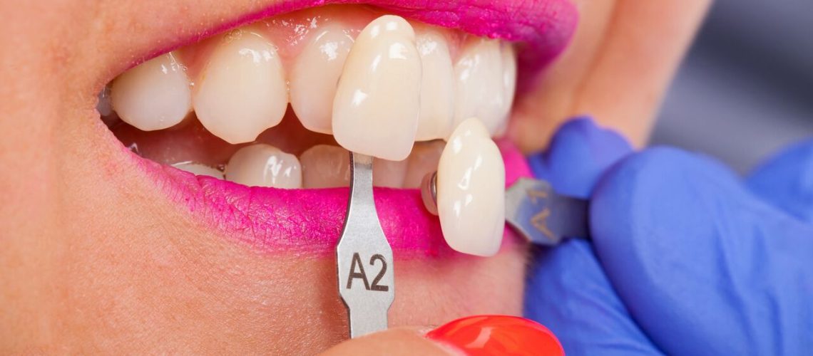 Fusion Dental Care (raleigh, Nc) Veneers