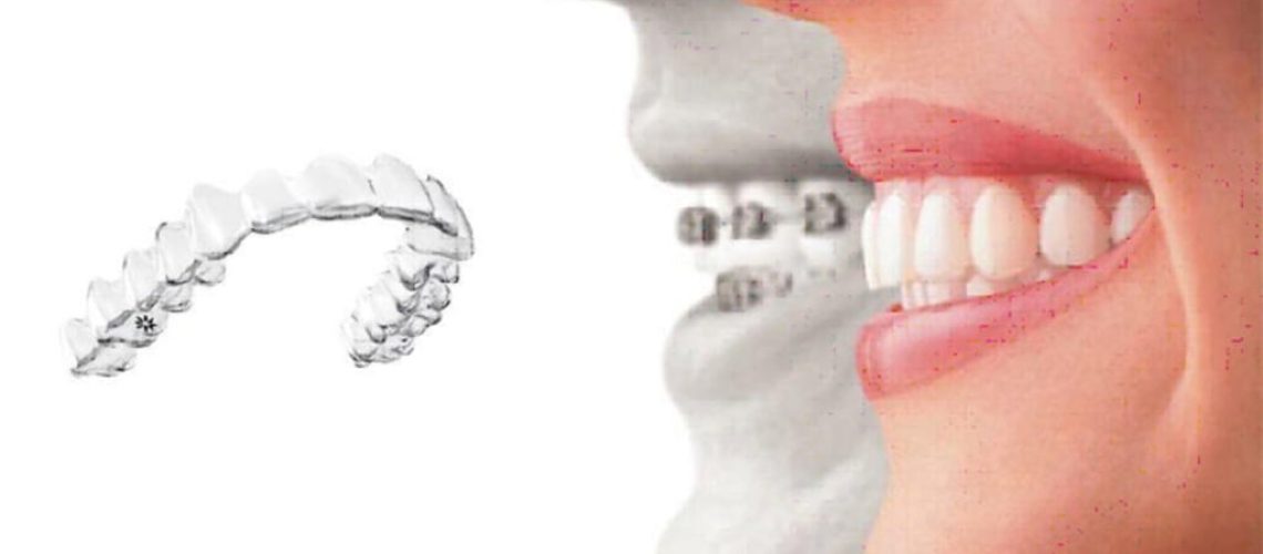 Invisalign Attacks What Are They And What Are They For