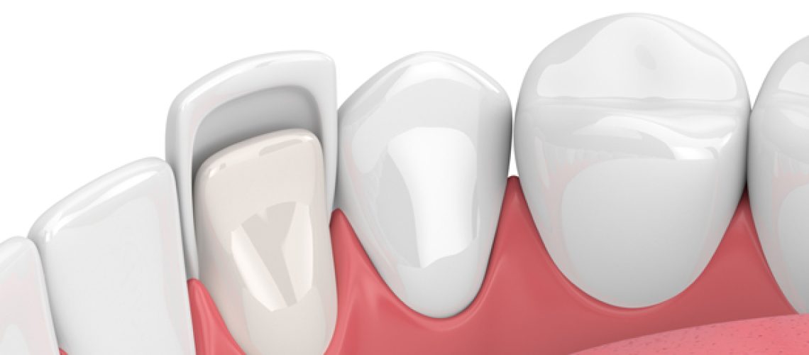 What Exactly Are Dental Veneers