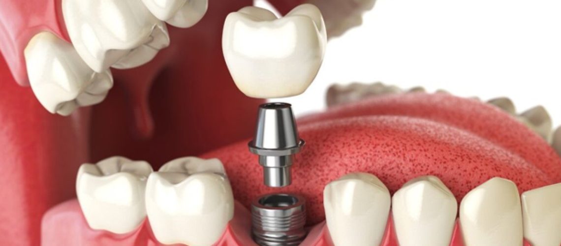 What Makes You A Candidate For Dental Implants