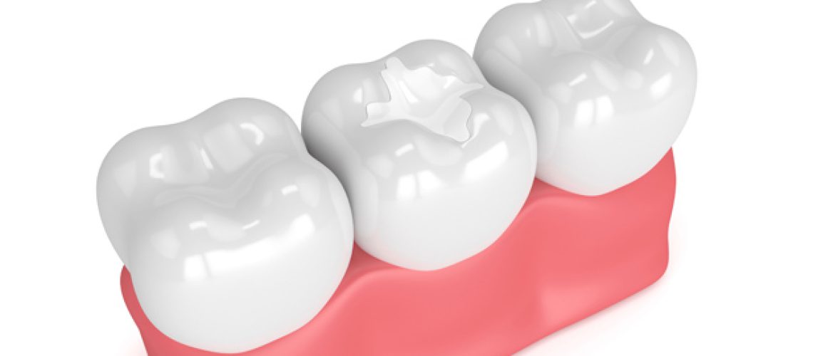 Who Is A Good Candidate For Dental Sealants